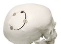 Eksempel på brug af craniofix-implantat.